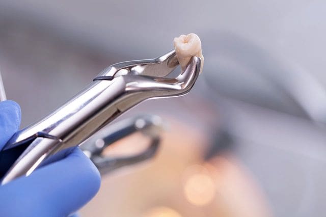 Tooth Extraction in Reno, NV