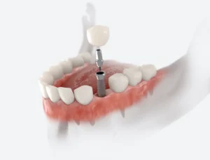 Dental Implants: A Step-by-Step Guide in Reno, NV