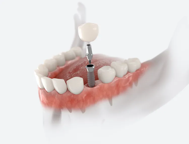 Dental Implants: A Step-by-Step Guide in Reno, NV